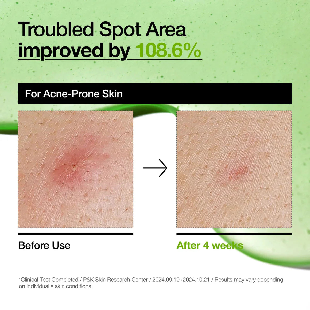 Anua Azelaic Acid 10 Hyaluron Redness Soothing Serum Anua